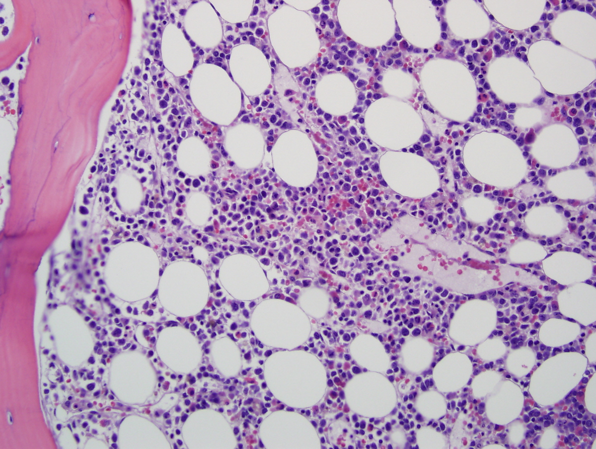 Bone marrow Biopsy July 2012